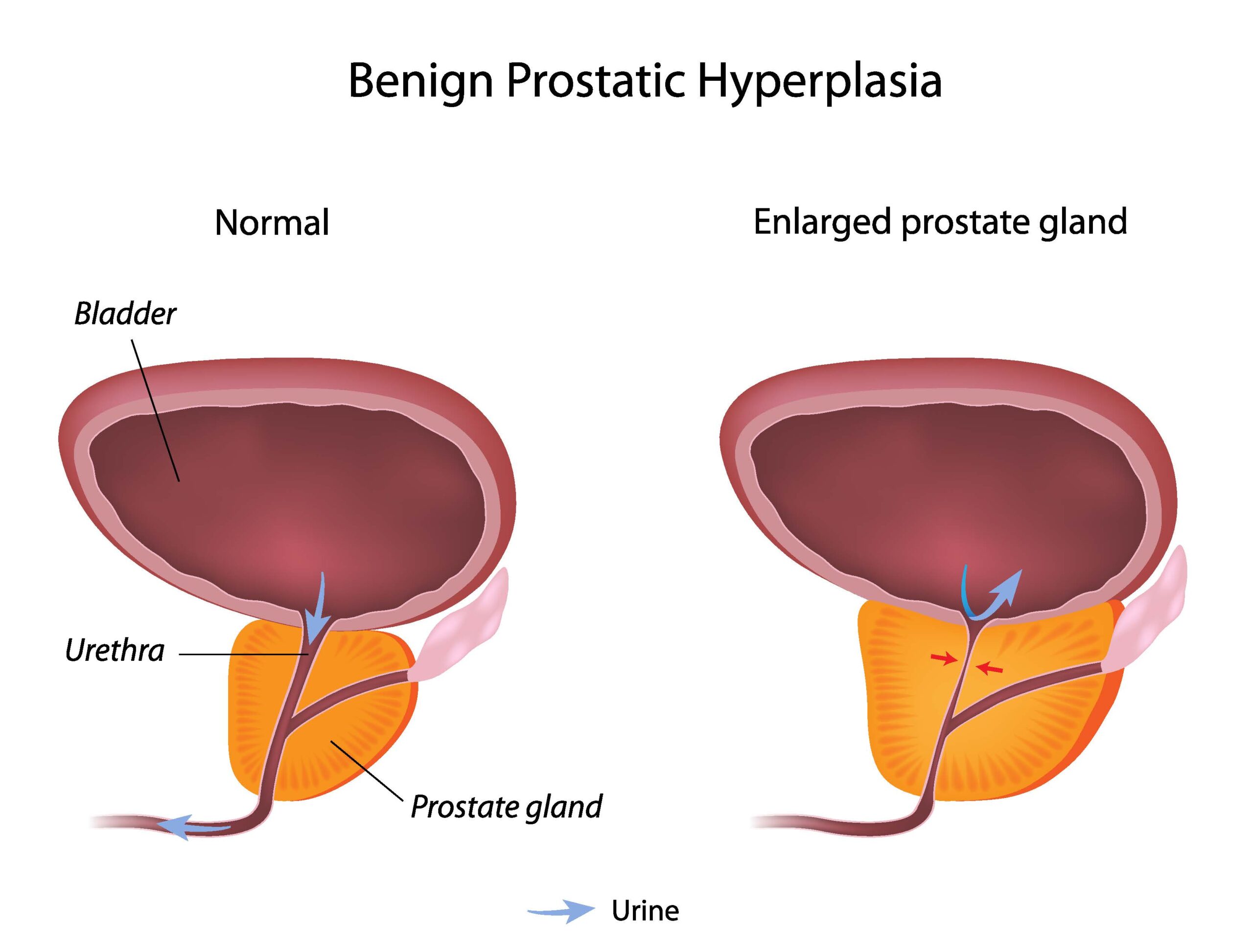 Enlarged Prostate And Urinary Tract Issues